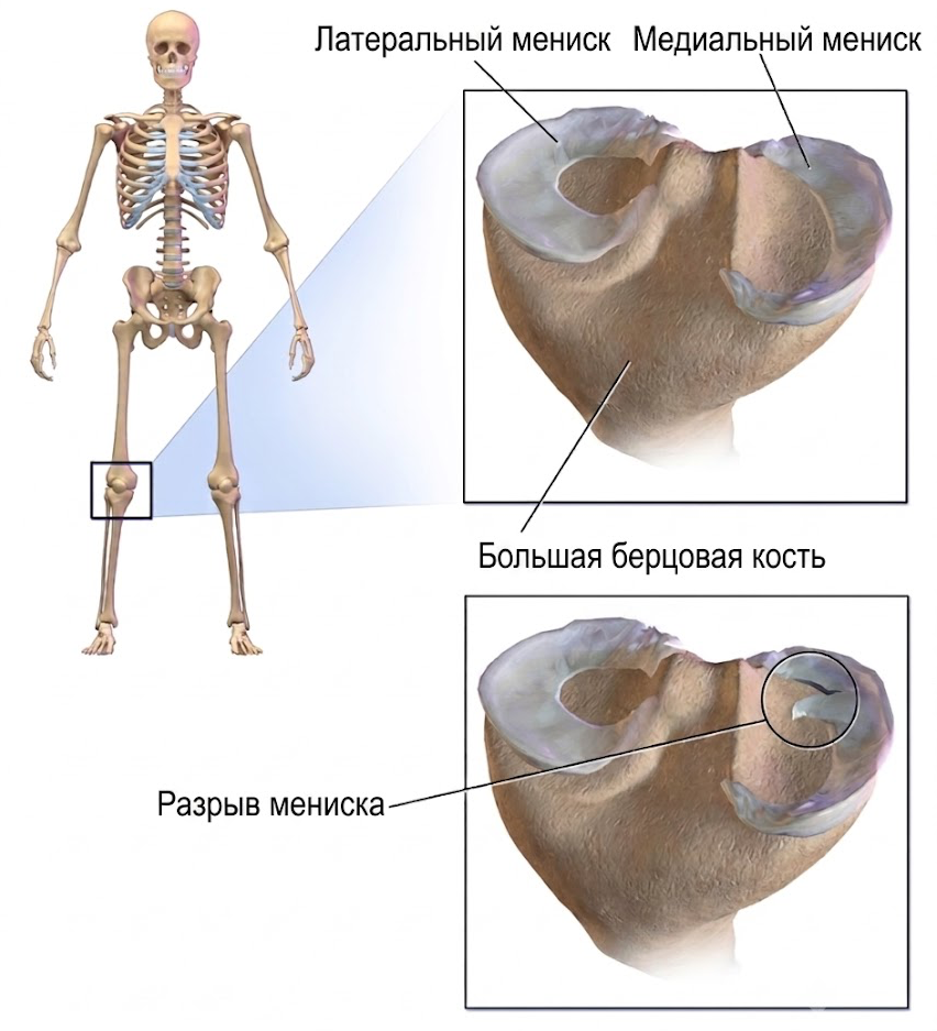 мениск 3